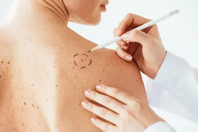 cirurgia de câncer de pele em Belém