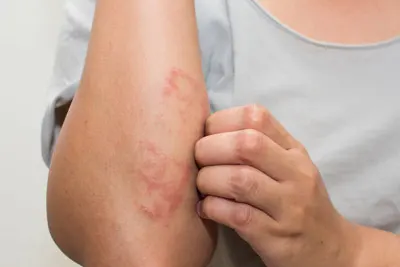 tratamento para dermatite em Belém