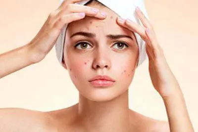 tratamento para espinhas e acne em Belém