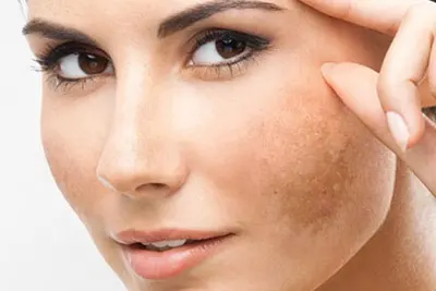 tratamento para melasma em Belém