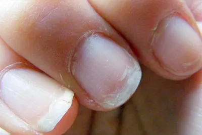 tratamento para unhas frágeis em Belém