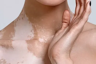 tratamento para vitiligo em Belém