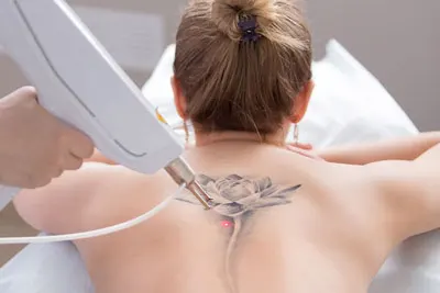 remoção de tatuagens em Belém