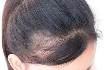 tratamento para alopécia frontal em Belém